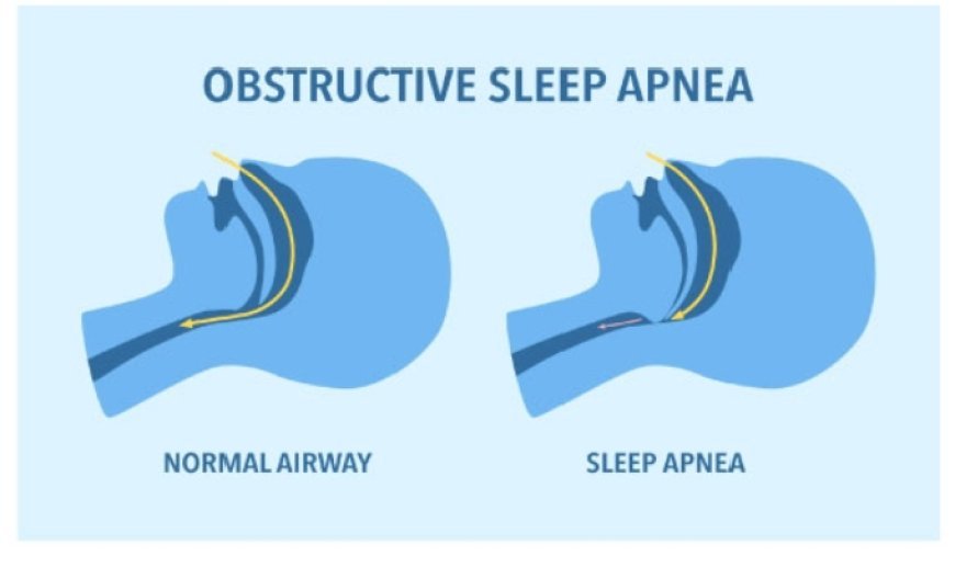 FDA Approves Zepbound for Apnea (Obstructive Sleep)